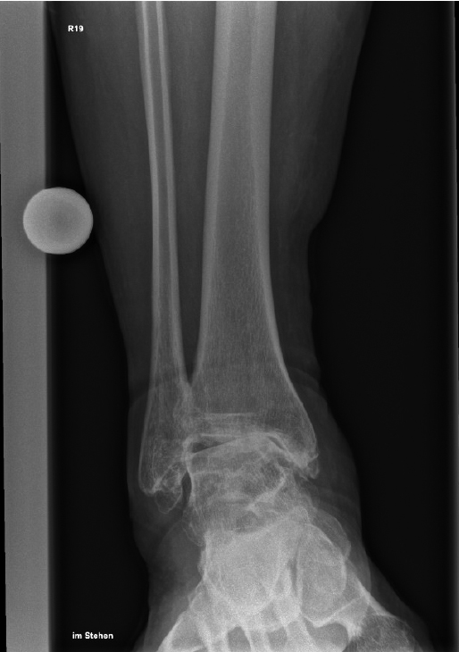 Röntgenaufnahme eines rechten Sprunggelenks mit Unterschenkelknochen zur medizinischen Diagnostik.